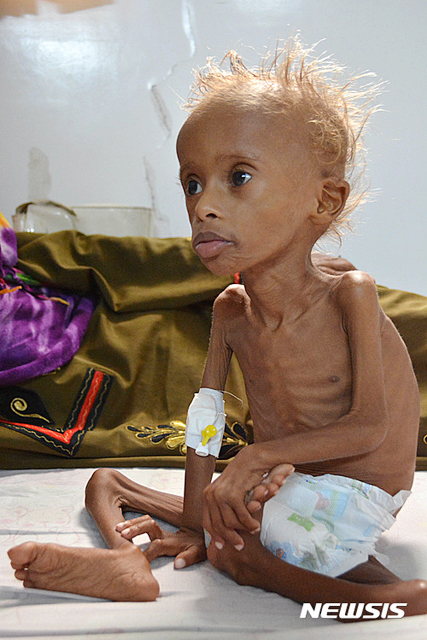 예멘 수도 사나 인근 후데이다의 한 병원에서 지난 9일(현지시간) 뼈만 앙상하게 남은 5살난 어린이가 치료를 받고 있다. 장기간 내란 중인 예멘에서는 5살 이하 어린이의 31%가 기아에 시달리고 있다. (출처: 뉴시스 사진캡처)